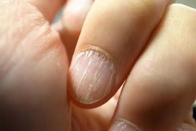 brittle fingernails