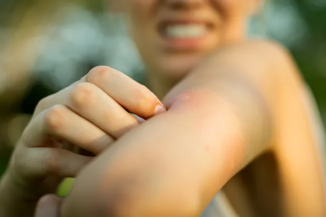 photo of bug bite