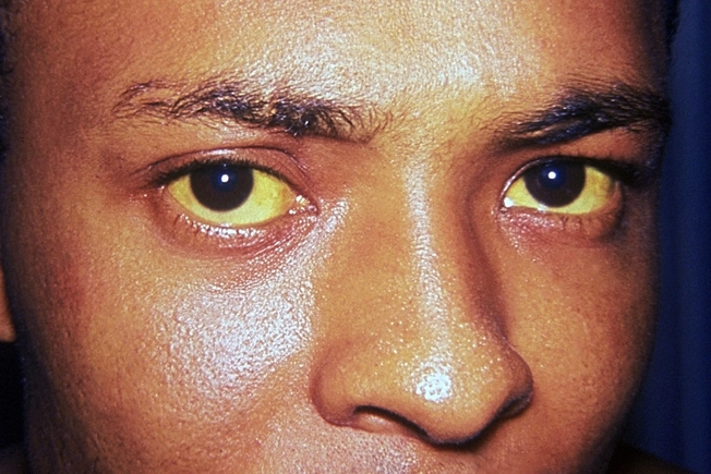 Yellow Skin or Eyes (Jaundice)