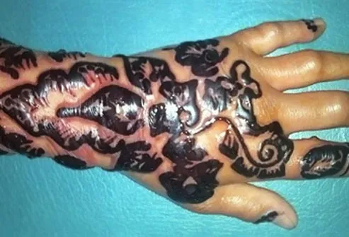 Pictures of Tattoo Problems Slideshow: When Tattoos Get 