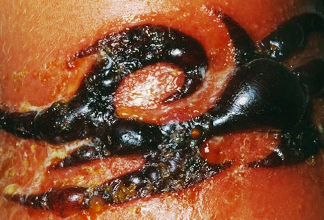Skin Infections