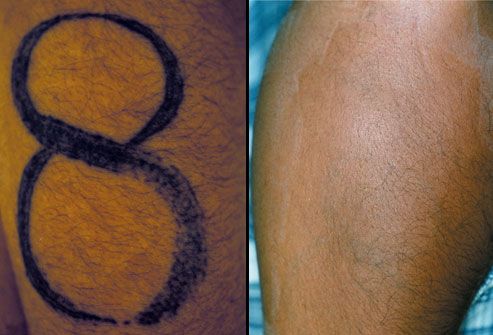 Tattoo Safety, and Safe Tattoo Removal