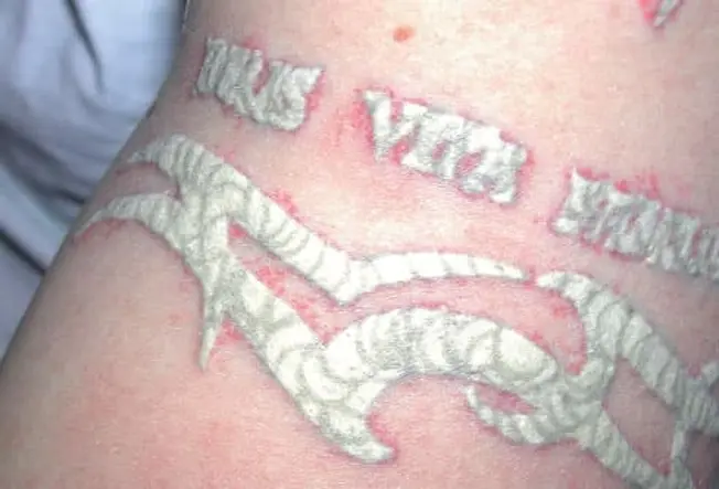 Tattoo Removal: What to Expect