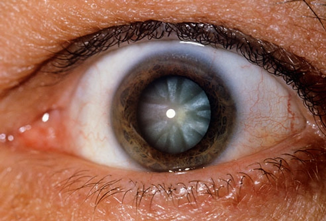 Cataracts and Glaucoma