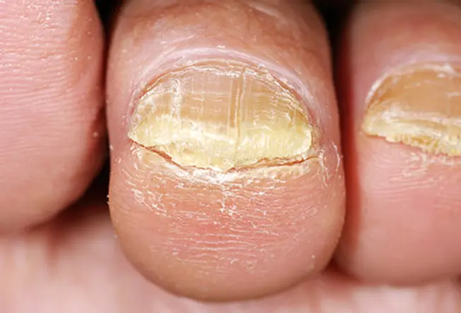 Qu'est-ce que la mycose des ongles?