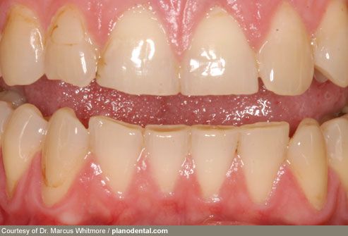 Bruxism Damaged Teeth