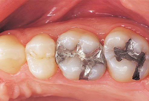 15 Common Dental Problems and Tooth Diseases