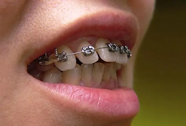9. Crooked Teeth