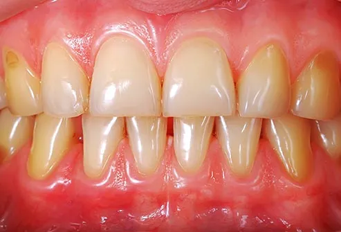 15 Common Dental Problems And Tooth Diseases