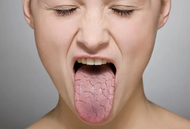 Medication Can Cause Dry Mouth