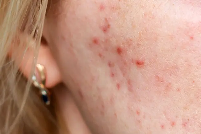 Skin Infections and Acne
