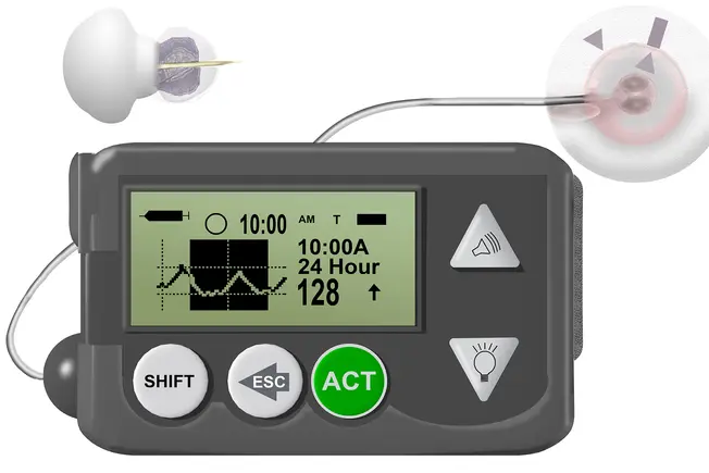 Could a Continuous Glucose Monitor Help?