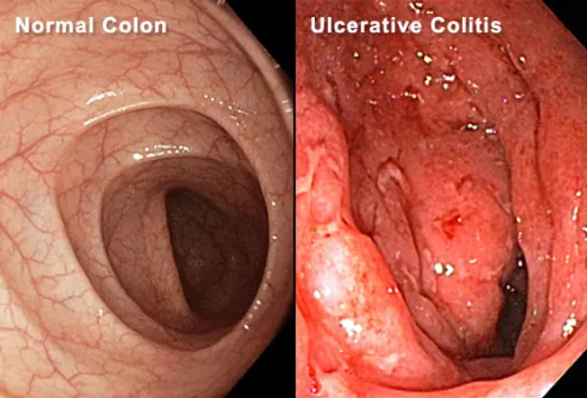 When Is Ulcerative Colitis Surgery Needed?