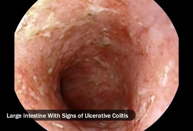 Ulcerative Colitis Pictures: Warning Signs of UC, How It's ...