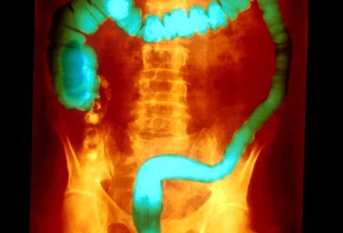 color xray of ulcerative colitis