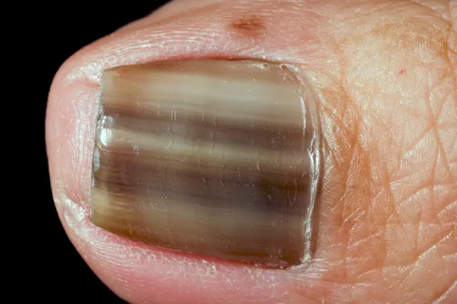 Under a Fingernail
