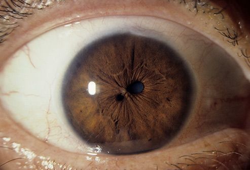 polycoria double pupil eye