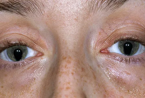 Pictures Of Unusual Eye Conditions
