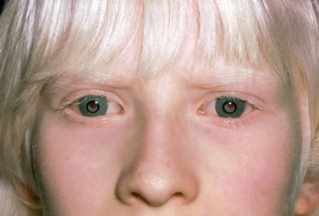 Ocular Albinism