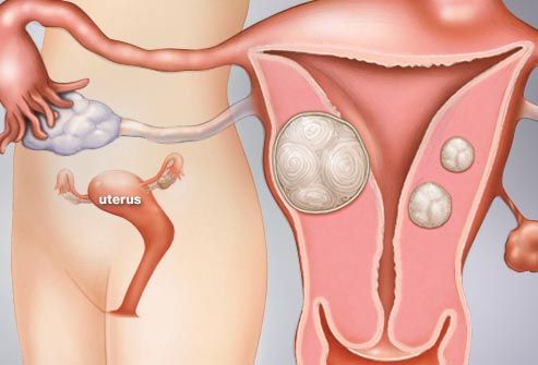 Uterine Fibroid Pictures: Anatomy Diagrams, Pictures of ...