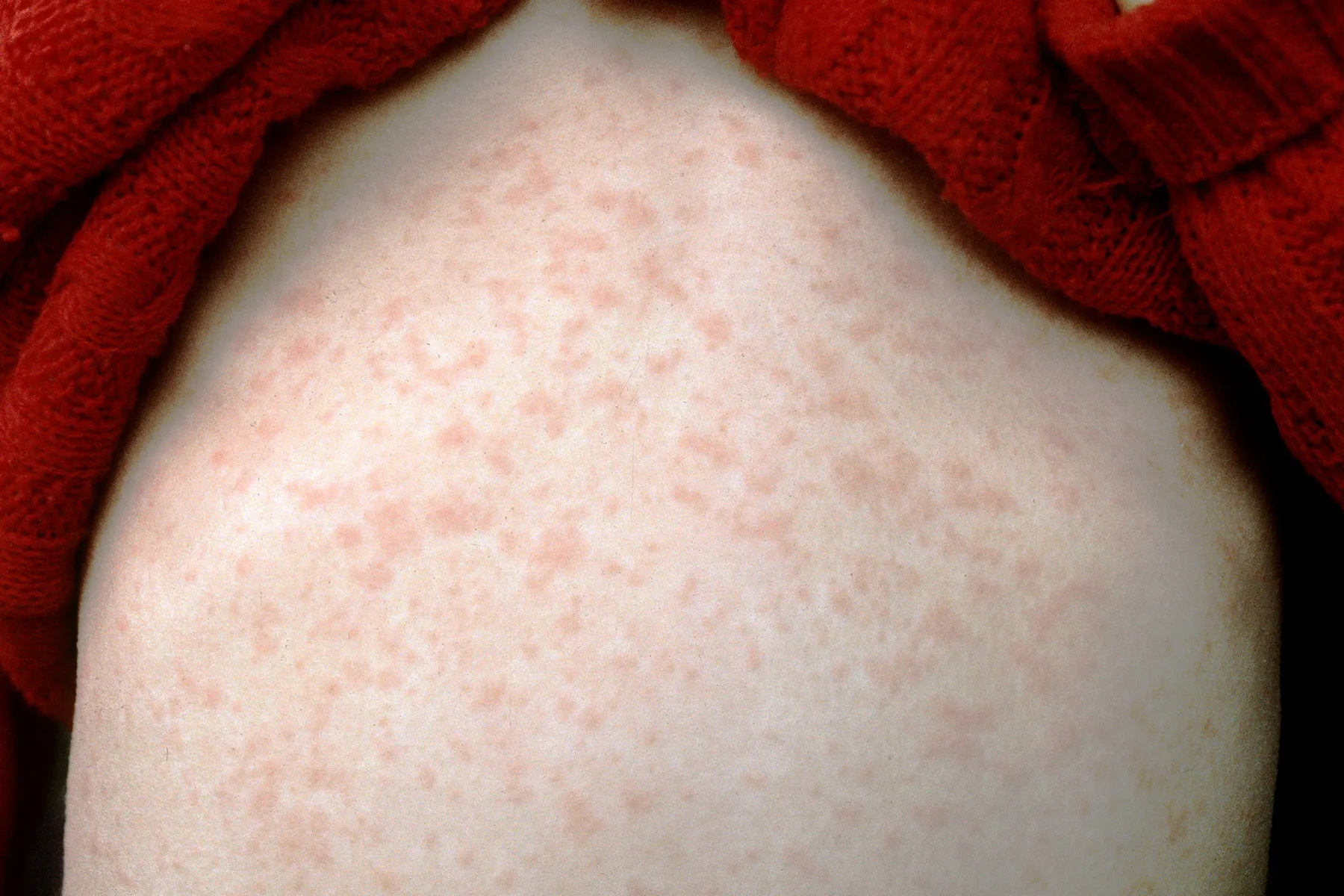 photo of measles rash