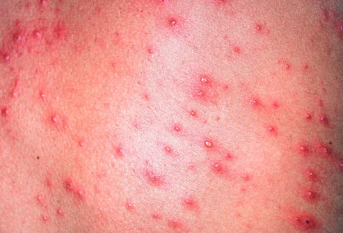 Close up of skin with chicken pox rash