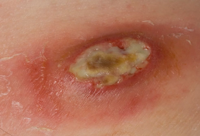 Ordinary Boil or MRSA Infection?