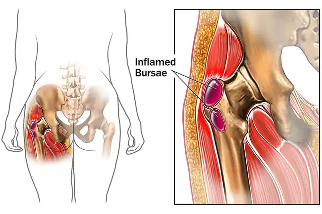 hip bursitis illustration