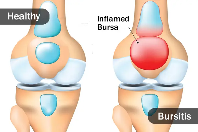 What Is Bursitis?