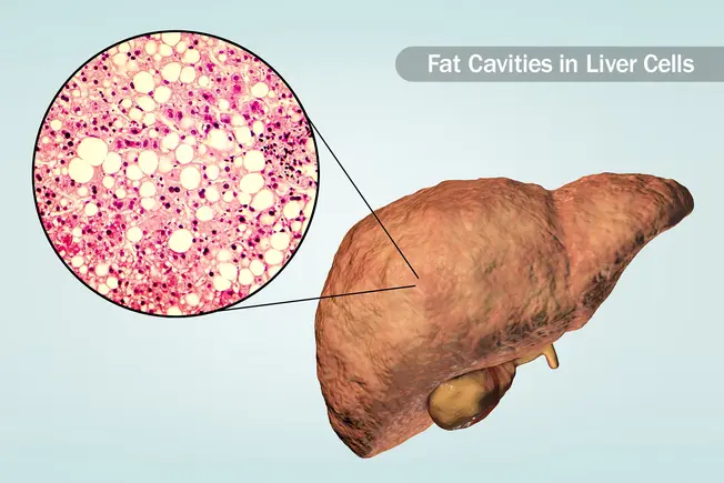 Cause: Nonalcoholic Fatty Liver Disease