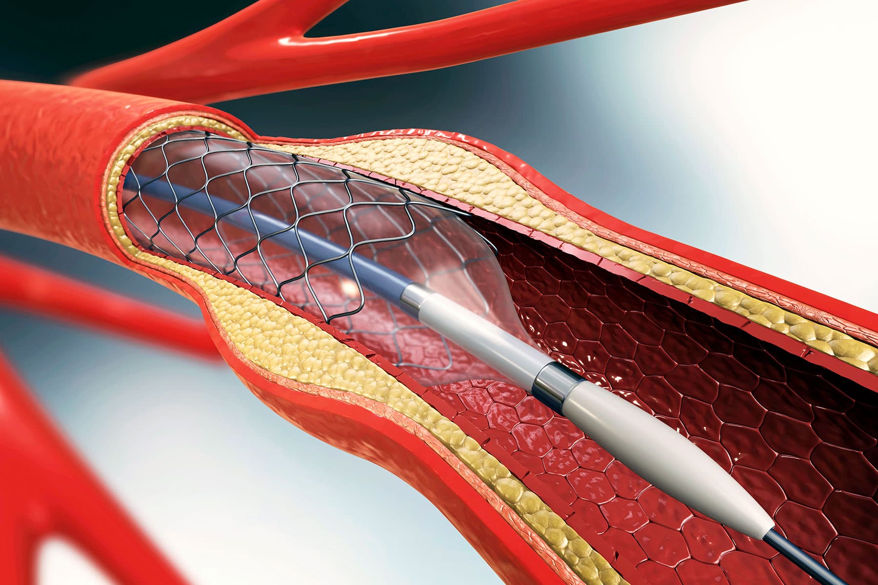 Dark Sufferers Fare Worse Than White Sufferers After Angioplasty, Stents thumbnail