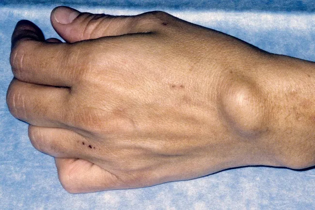 Cysts On Skin Pictures Of What They Look Like
