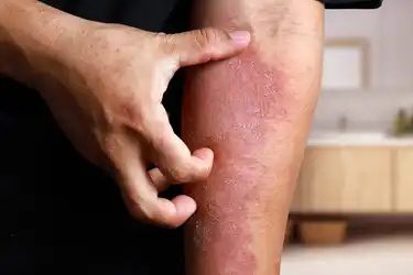 Eczema Pictures What An Eczema Rash Looks Like