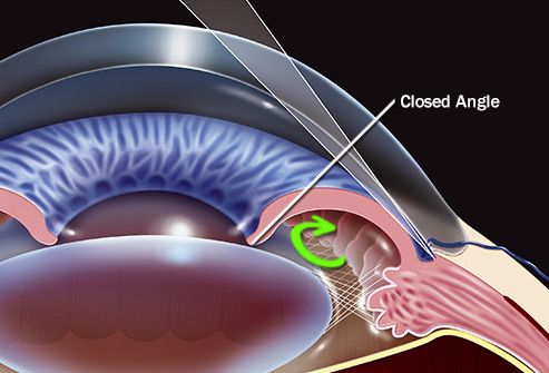 angle closure glaucoma