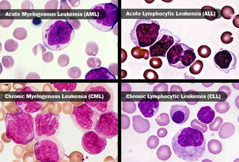 common types of leukemia
