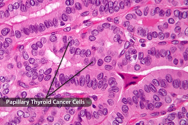Differentiated Thyroid Cancers