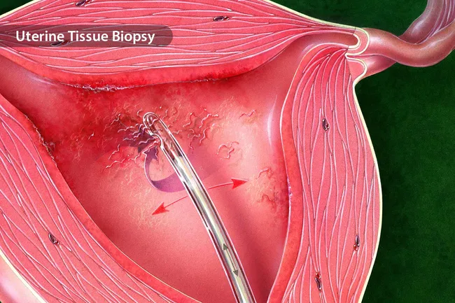 uterine tissue biopsy