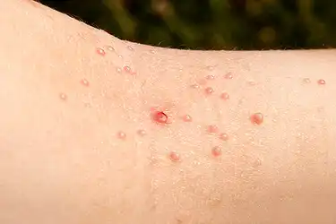hpv warts under arms)