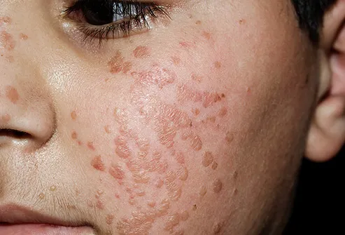 Warts on baby skin