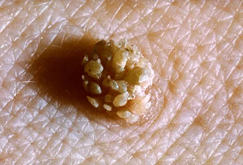 Wart on face or skin cancer. Clavusin indications, Warts and skin cancer