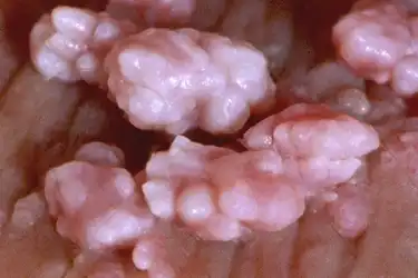 human papilloma papilloma