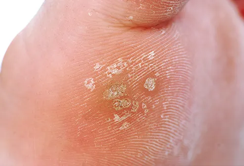 Warts on my hands and feet, Warts on my hands