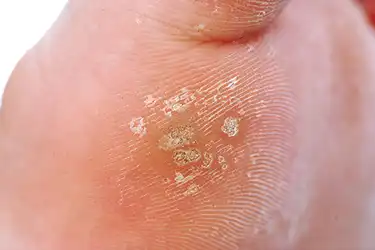 wart on foot finger)