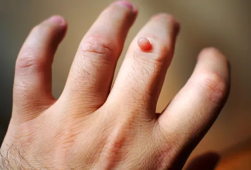 Human papillomavirus on hands. Human papillomavirus warts on hands Hpv infection finger