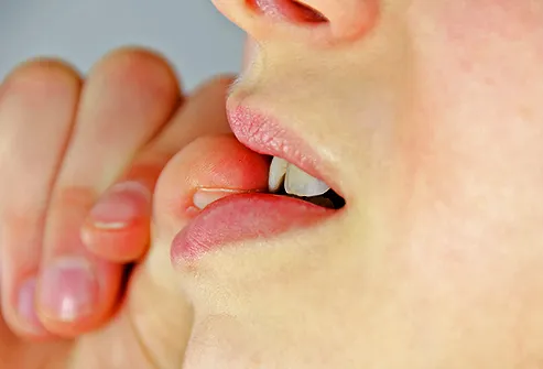 Human papillomavirus warts in mouth. Human papilloma in mouth