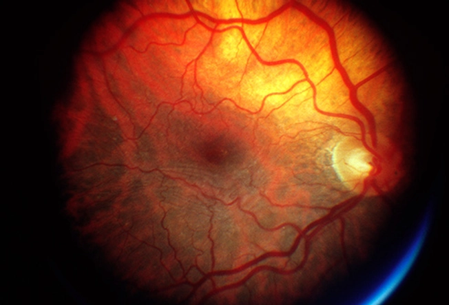 May Help Prevent Age-Related Macular Degeneration (AMD)