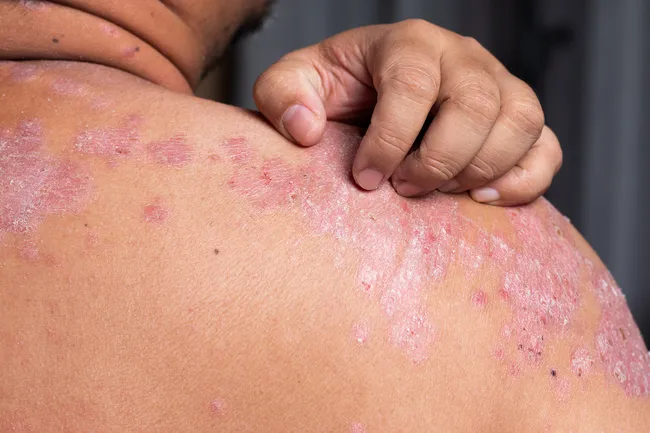 photo of psoriasis on shoulder