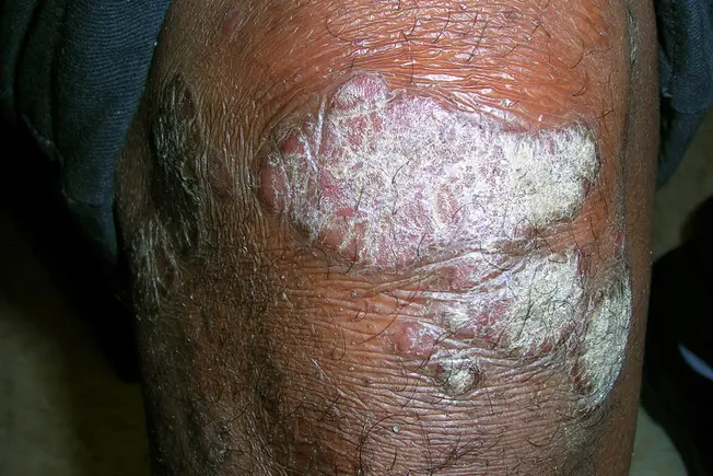 Psoriasis in Skin of Color