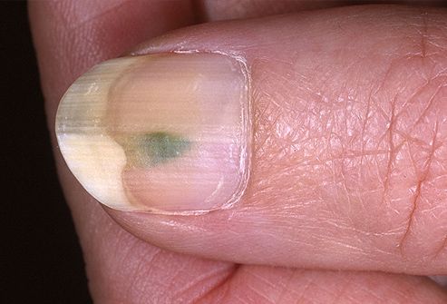 Green coloration on finger nail