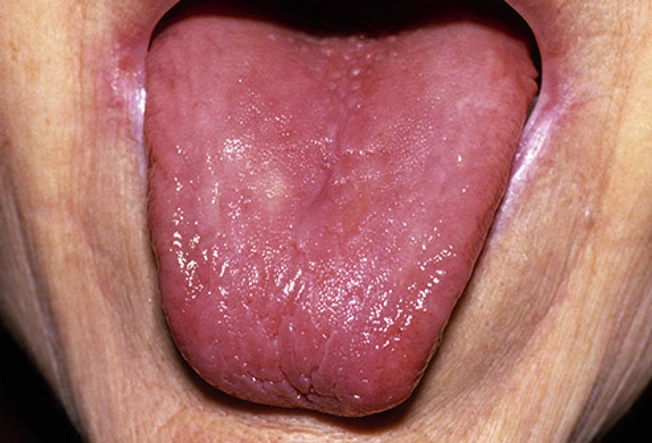 Bald Tongue